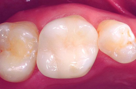 4. Einfügen des Zahnersatzes