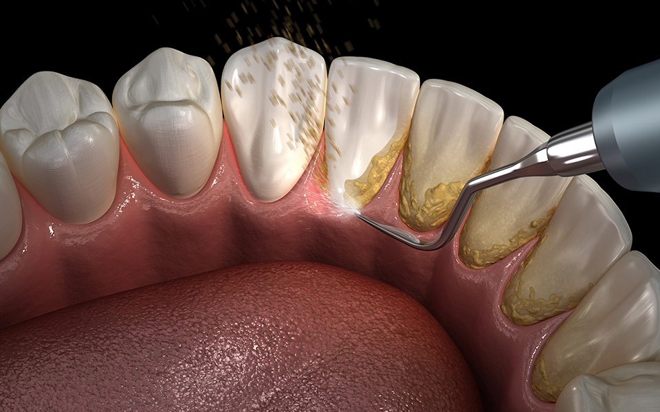 Weitere Behandlungsmöglichkeiten in der: Parodontologie